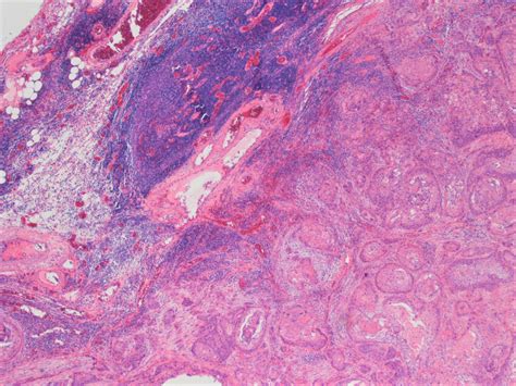 Histopathological Image Of The Biopsy From The Cranial Mediastinal Mass