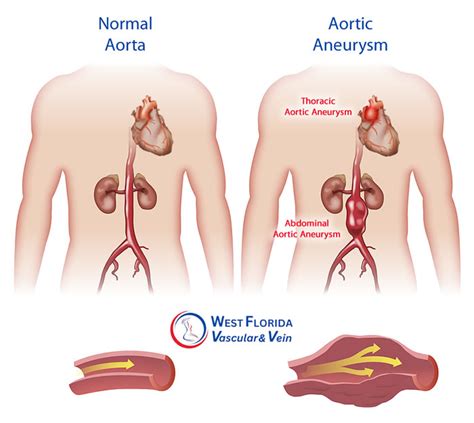 Tampa Aortic Aneurysm Surgery Treatment Center | Safety Harbor