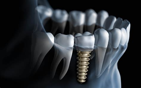 Implantes Dentários Divinópolis Dr Luís MoratoDr Luís Morato