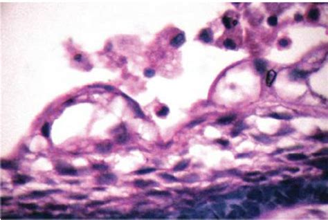 Hyperchromatic Nuclei In Basal Columnar Cells Download Scientific Diagram