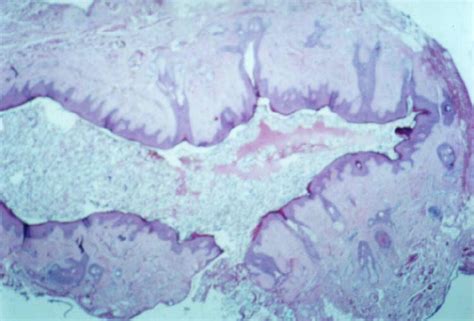 Low Power Microscopy The Cystic Lesion Is Lined By A Stratified