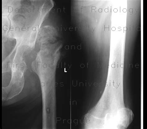 Radiology Case Bone Sequestration Osteomyelitis