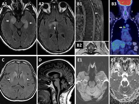 Imaging Findings In Paraneoplastic Neurologic Disorders And Its Mimics Download Scientific