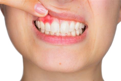 Gingivitis qué es y cómo se cura Clínica Dental Mediterráneo