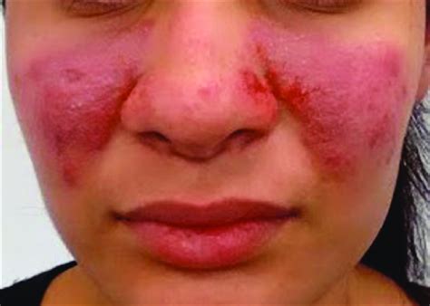 Erythematous Plaque Following Application Of Brimonidine For Rosacea Download Scientific Diagram