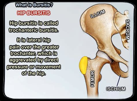 5 Bursitis Knee Hip Elbow Shoulder Dr Nabil Ebraheim S Blog