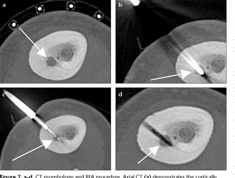 Table From Ct Guided Radiofrequency Ablation Of Osteoid Osteoma