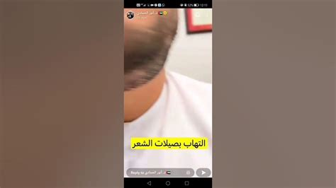 ثعلبه ام التهاب بصيلات الشعر ؟ سناب الدكتور أنور الحمادي Youtube