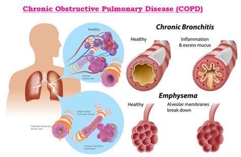 Copd Lung Disease Emphysema - PELAJARAN