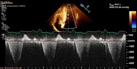 Echocardiography Assessment At Rest In A Year Old Male With