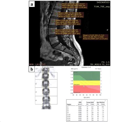 Lumbar Mri Of A 55 Year Old Post Menopausal Woman Complained From Low