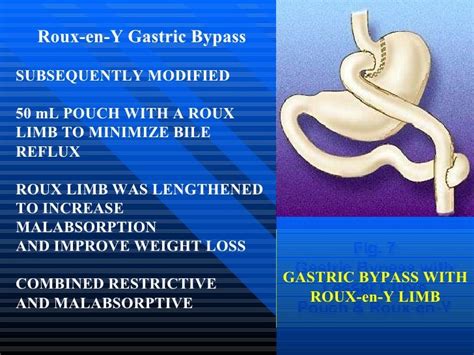 Laparoscopic Roux En Y Gastric Bypass One Surgeons Technique