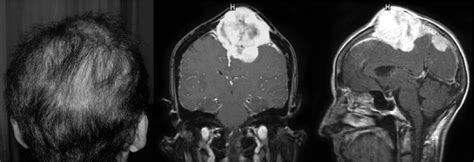 Radiation Induced Meningioma In Neurosurgical Focus Volume Issue