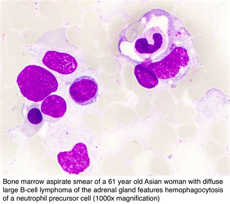 Pathology Outlines Hemophagocytic Lymphohistiocytosis