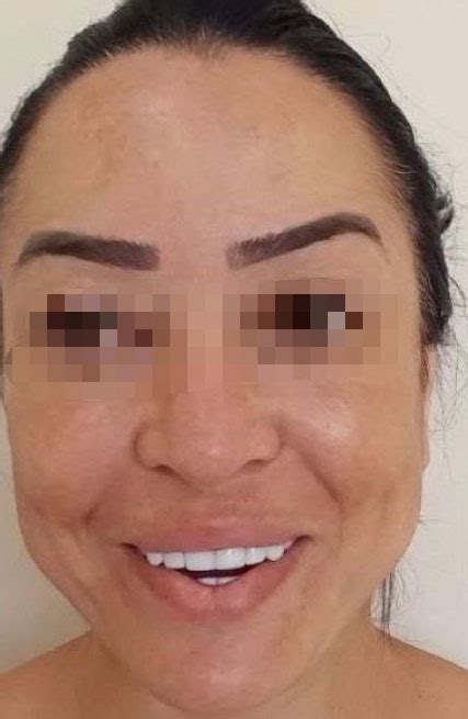 Conheça Mais Sobre Toxina Botulínica Botox Kat Transforma