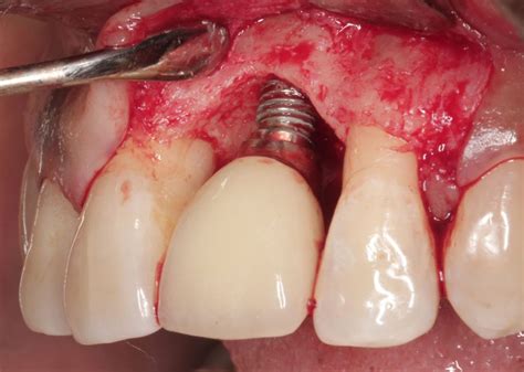 Periimplantitis Odontologists