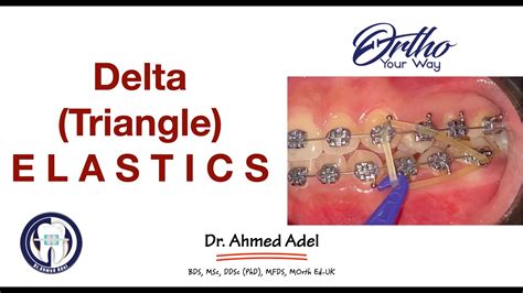 Delta Triangle Vertical Settling Elastics Orthodontics YouTube