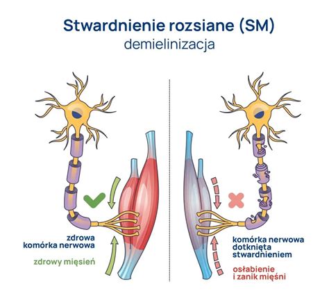 Stwardnienie Rozsiane Gro Na I Podst Pna Choroba