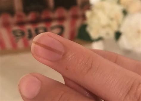 What Vitamin Deficiency Causes Black Lines On Nails Lines On Nails