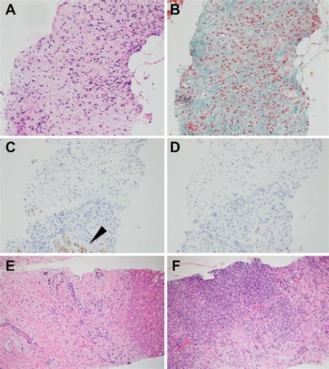 Figure3 Histological Findings Of The Hepatic Inflammatory Pseudotumor