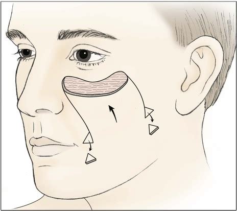 Reconstruction Of The Cheek Plastic Surgery Key