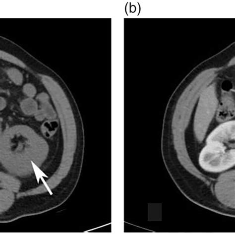 Contrast Enhanced Abdominal Computed Tomography Showing An Isodensity