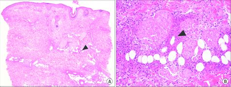 A Heavy Perivascular And Interstitial Neutrophilic Infiltration Download Scientific Diagram