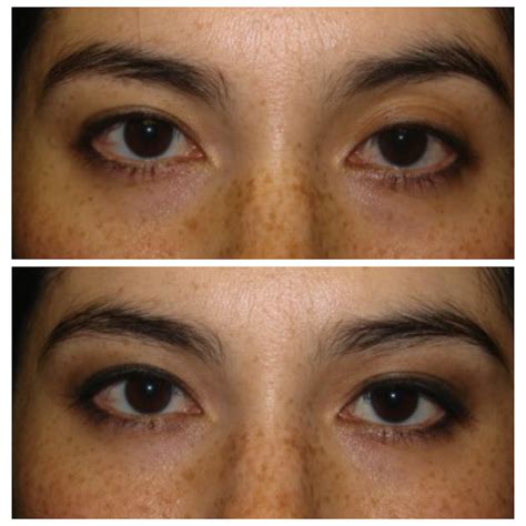 Restylane Filler In Upper Eyelids Dr Guy Massry