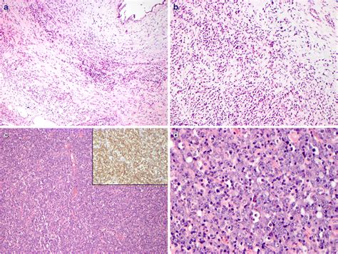 Case 5 DLBCL Occurring After The Diagnosis Of IgG4 RD A 74 Year Old