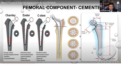 Biomechanics Of Total Hip Replacement For The Frcsorth