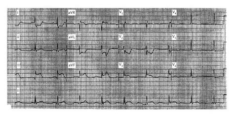 Use Of The Electrocardiogram In Acute Myocardial Infarction Nejm