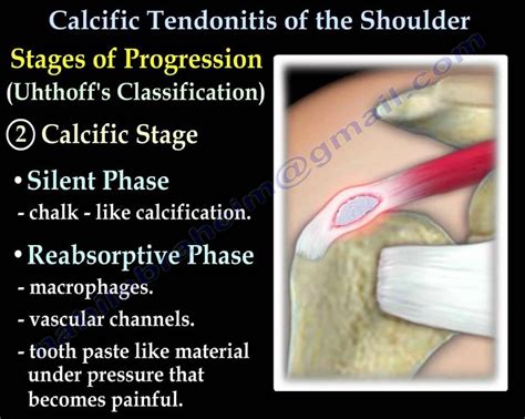 8 best Calcific Tendonitis of the Shoulder images on Pinterest | Physical therapy, Exercises and ...