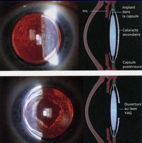 Cataracte Secondaire Laser YAG Centre Ophtalmologique Agora