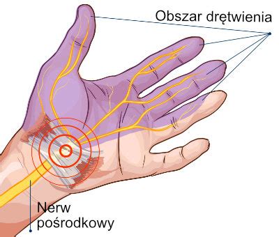 Dr Twienie R K Lewej I Prawej Przyczyny