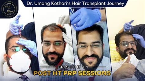 Dr Umang Kothari S Hair Transplant Journey Ep 11 Post Ht Prp Sessions Big Fue