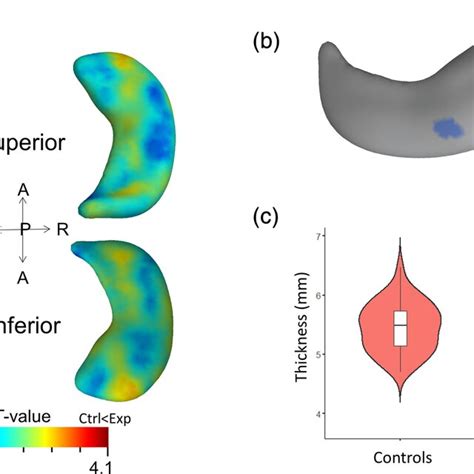 Example Of Hippocampal Shape Analysis A And Hippocampal Subfield Download Scientific Diagram