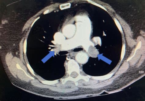 Recurrent Syncope As A Presentation Of Pulmonary Embolism Pmc