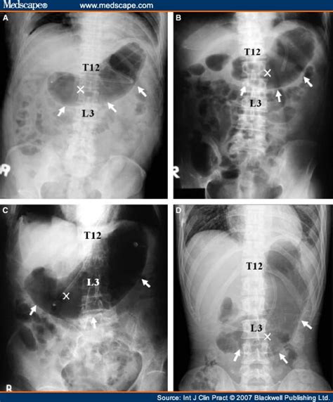 Safe Gastric Puncture Point Before Percutaneous Endoscopic Gastrostomy