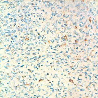 Embryonal rhabdomyosarcoma, histology (RMS x20). Presence of spindle... | Download Scientific ...