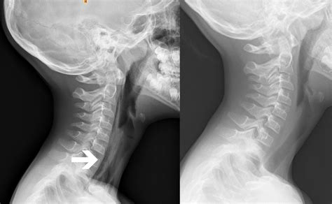 Left Lateral Cervical Radiograph Evincing The Presence Of Ectopic Air