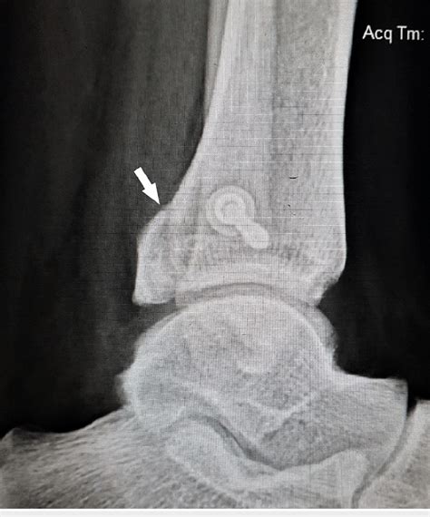 Postoperative Lateral View Radiograph Of The Left Ankle At Three