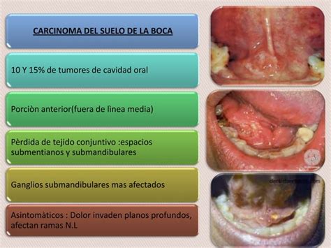 Tumores Malignos De La Cavidad Oral PPT