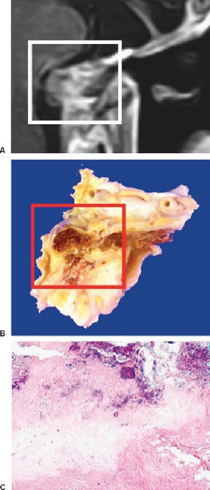 A Final Magnetic Resonance Image B Macroscopic View Of The Tumor Download Scientific