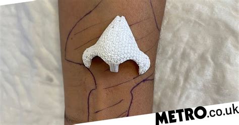 3d Printed Nose Implanted In Forearm To Help It Grow Properly Trendradars