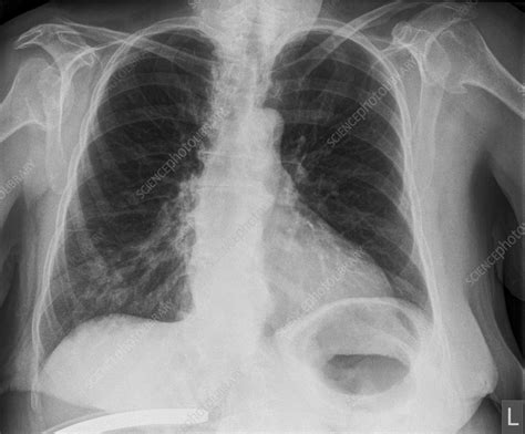 Pneumonia X Ray Stock Image C056 4051 Science Photo Library