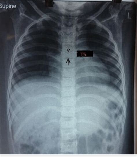 Chest X Ray Showing Butterfly Presentation Of The T5 Vertebra