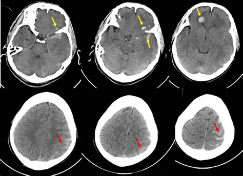 Traumatic Contusion And Subarachnoid Hemorrhage Radiology Cases