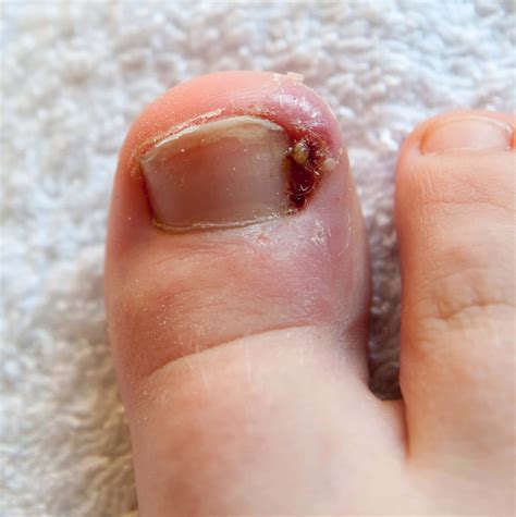 Ingrown Toenail Treatment In Singapore Assurance Skin