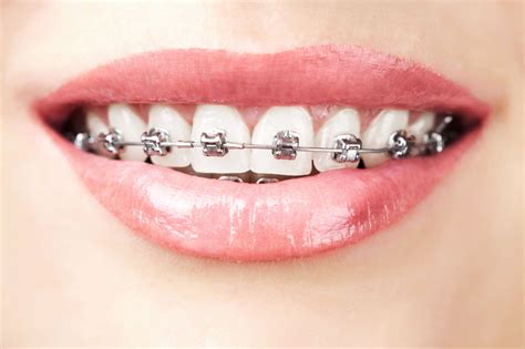 Metal Braces Dr Mathias