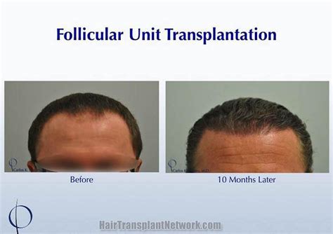 Dr Carlos Wesley Hair Restoration Procedure Before And After Result